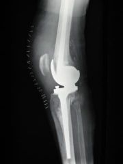 Knie